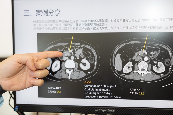 廖亭凱醫師於記者會分享胰臟癌治療新里程【術前化療合併擴大切除】圖片