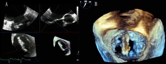 3D經食道超音波示意圖：左圖A為術前立體定位並量測瓣膜長度是否足夠夾取；右圖B 為手術進行中導引準確夾取部位與評估角度適當性等。