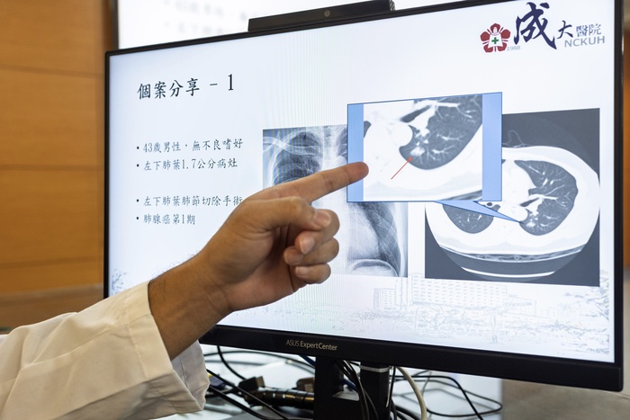 吳晨宇醫師於記者會分享【低劑量電腦斷層】協助早期診斷肺癌議題圖片