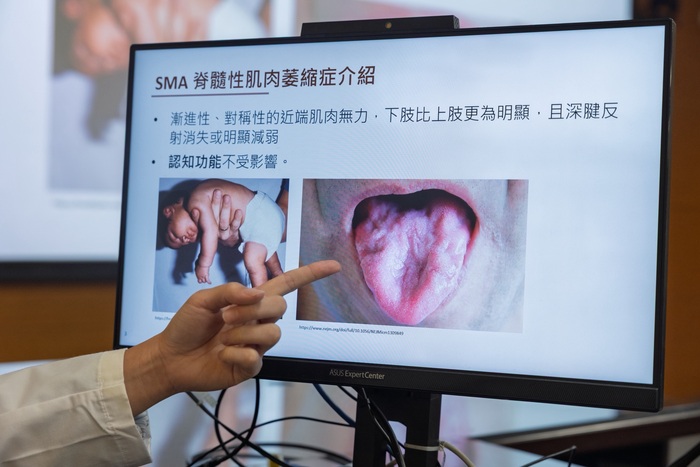 吳博銘醫師於記者會分享【脊髓性肌肉萎縮症(SMA)】治療新里程圖片