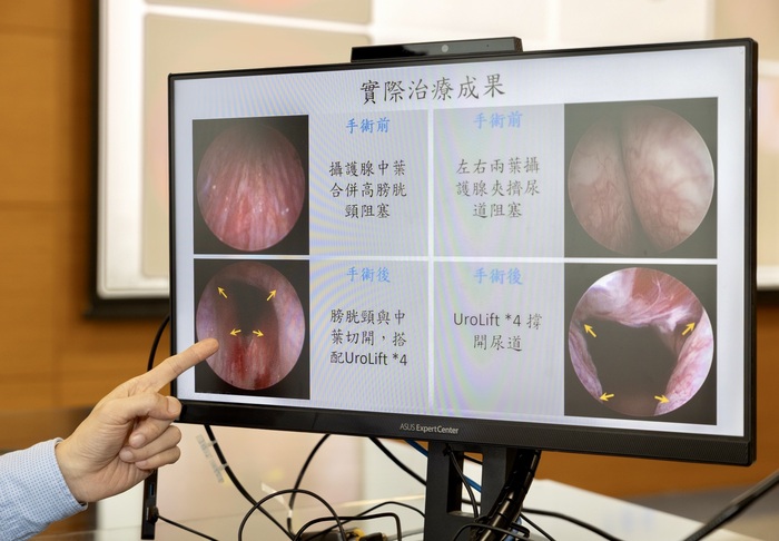 歐穎謙醫師於記者會分享【UroLift微創攝護腺拉提手術】圖片