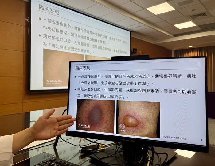 葉芮彣醫師於記者會分享【固定型藥物疹】議題圖片