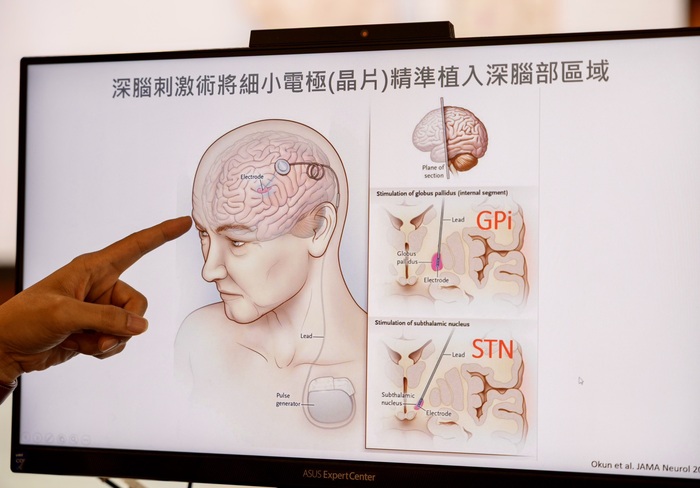 李宗霖醫師於記者會分享【深腦刺激術】圖片