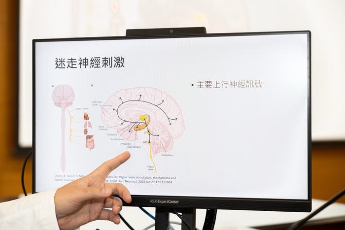 李柏萱醫師於記者會分享【迷走神經刺激術】圖片