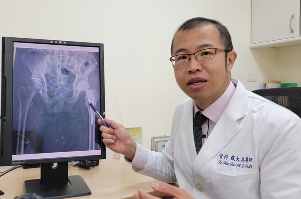 骨科戴大為醫師指出，高齡患者移位性股骨頸骨折的治療首選，是置換雙極式半人工髖關節圖片